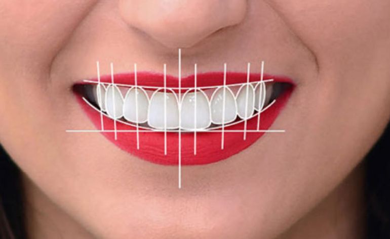 Smile Designing